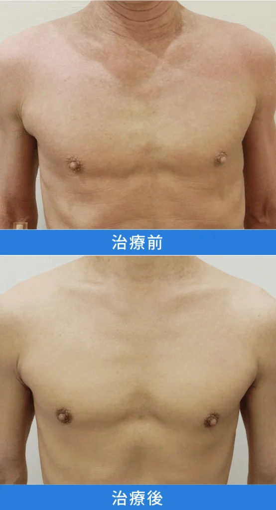 アトピー性皮膚炎治療 デュピクセント症例写真：上胸