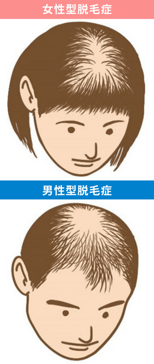 FPHL/FAGA(女性型脱毛症)の症状