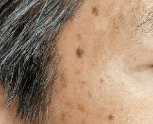 脂漏性角化症（老人性イボ）の症状