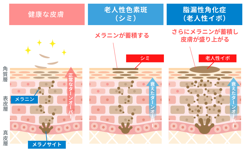 脂漏性角化症（老人性イボ）の原因