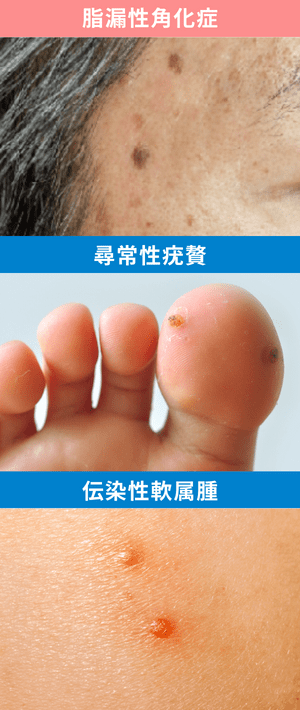 脂漏性角化症（老人性イボ）と、イボの種類と違い