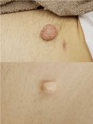 皮膚腫瘍(できもの)の種類:軟性線維腫(アクロコルドン)