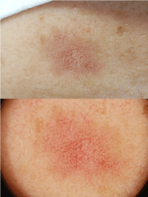 皮膚腫瘍(できもの)の種類:日光角化症