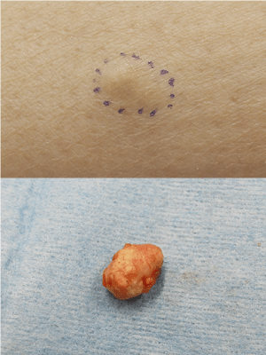 皮膚腫瘍(できもの)の種類:石灰化上皮腫(毛母腫)