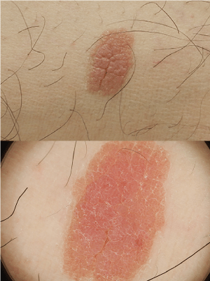 皮膚腫瘍(できもの)の種類:エクリン汗孔腫