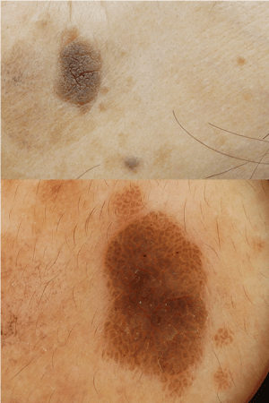 皮膚腫瘍(できもの)の種類:脂漏性角化症