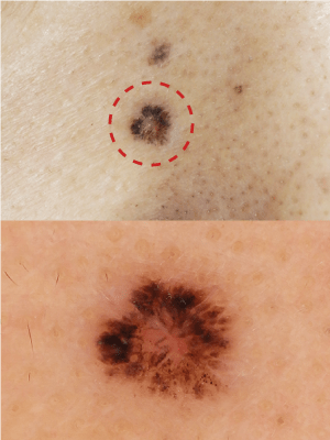 皮膚腫瘍(できもの)の種類:基底細胞癌