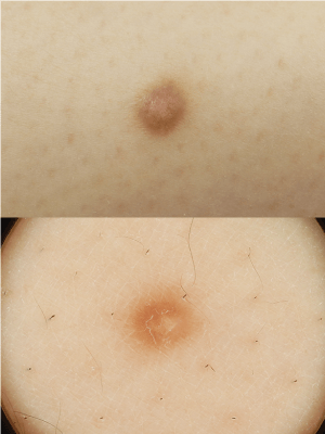 皮膚腫瘍(できもの)の種類:皮膚線維腫