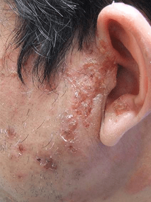 接触皮膚炎（かぶれ）：毛染めによる刺激性接触皮膚炎の症状