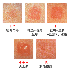 アレルギー性接触皮膚炎の判定基準