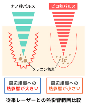 ピコレーザーと従来レーザーの熱影響範囲の比較
