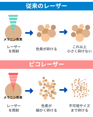 ピコシュア®(PicoSure®)のシミ改善効果