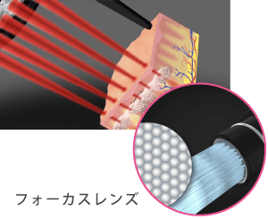 ピコシュア®(PicoSure®):最小限のダウンタイム