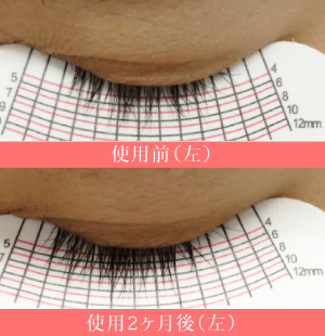ビマトプロストの当院症例1(左)
