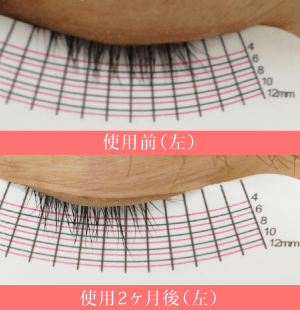 ビマトプロストの当院症例2(左)