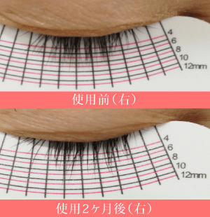 ビマトプロストの当院症例2(右)