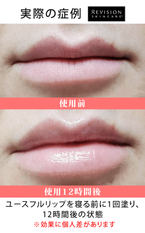 ユースフルリップ(YouthFull Lip Replenisher™):使用12時間後の症例