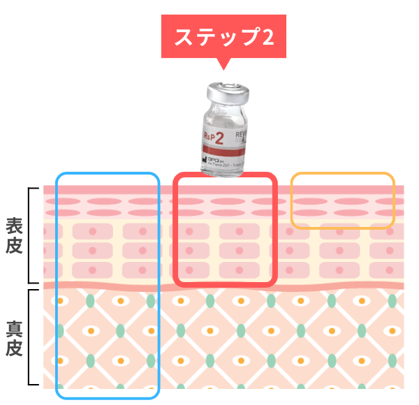 肝斑治療に有効な革新的リバースピール(REVERSE PEEL)ーステップ2:表皮中~深層