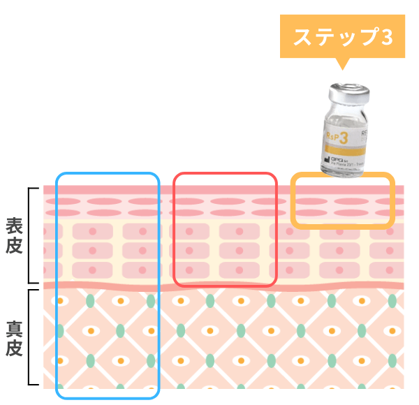 肝斑治療に有効な革新的リバースピール(REVERSE PEEL)ーステップ3:表皮浅層