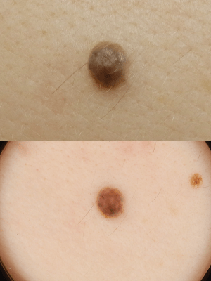 皮膚腫瘍(できもの)の種類:ほくろ(母斑細胞母斑)1