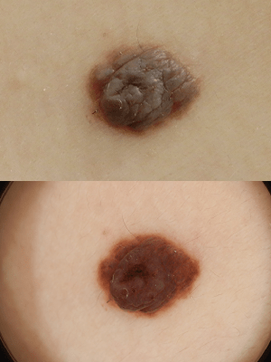 皮膚腫瘍(できもの)の種類:ほくろ(母斑細胞母斑)2