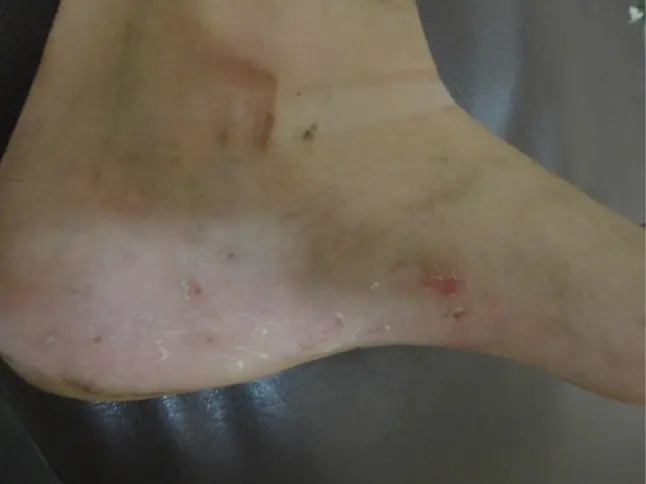 砂かぶれ様皮膚炎症例01