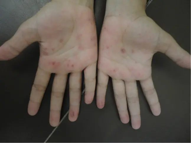 砂かぶれ様皮膚炎症例02