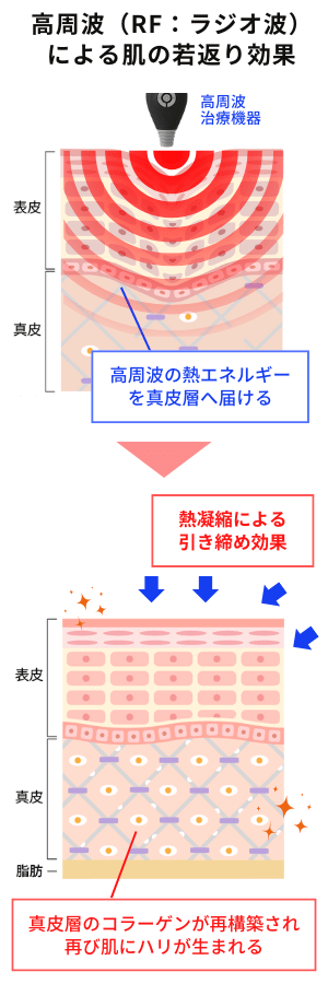 高周波(RF:ラジオ波)による肌の若返り(スキンリジュビネーション)効果