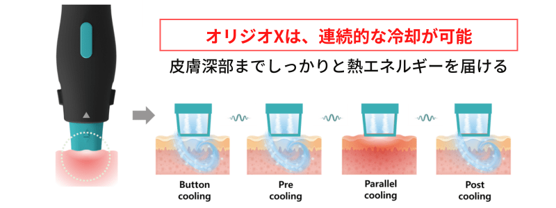 痛み、ダウンタイムを軽減したオリジオX(OligioX)