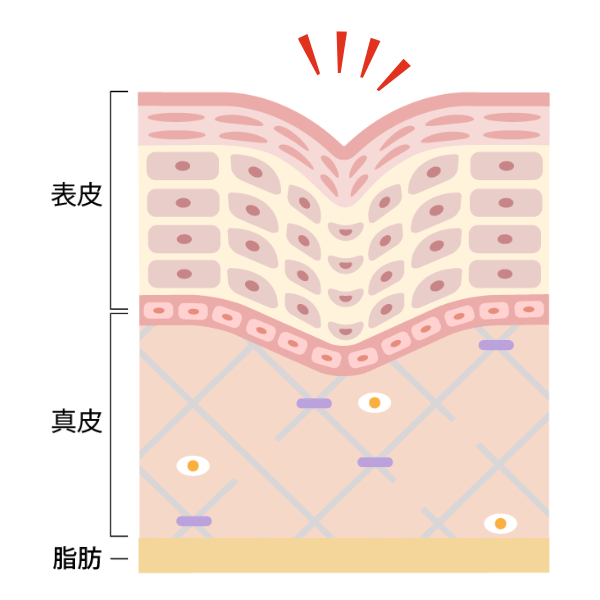 ニールワン®のシワブロック機能3