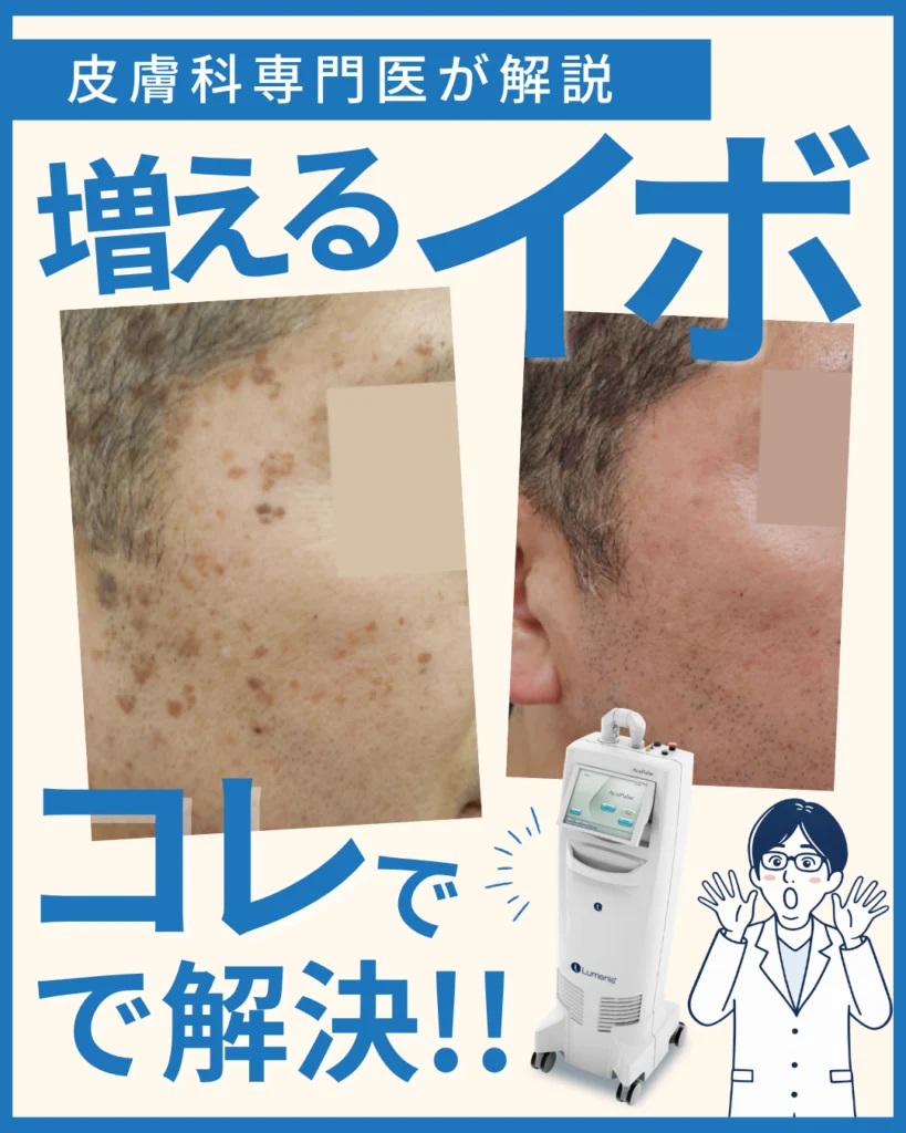 増えるイボ(脂漏性角化症)の原因と治療法