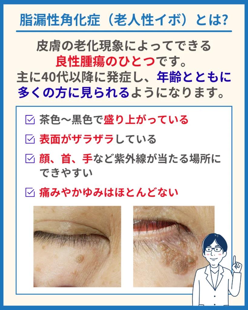 脂漏性角化症(老人性イボ)とは