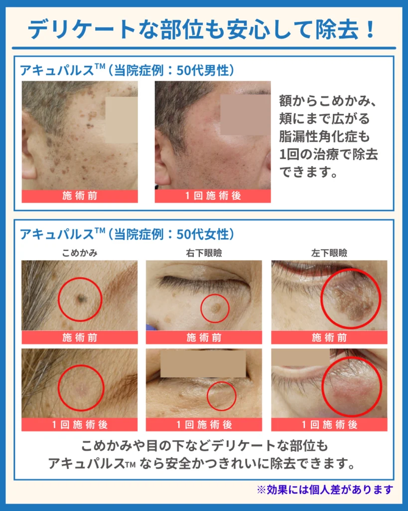 「AcuPulse™(アキュパルス)」による当院症例