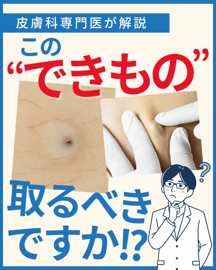 粉瘤(ふんりゅう)とは?放置するリスクと治療法