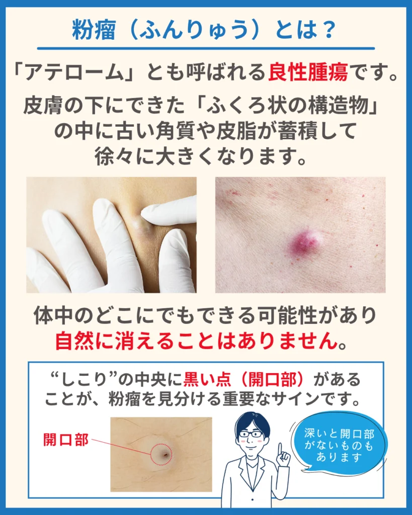 粉瘤(ふんりゅう)とは