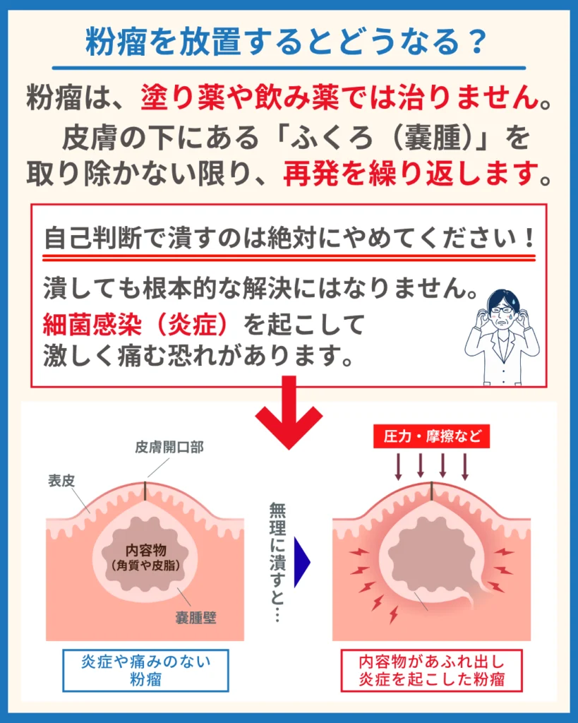 粉瘤(ふんりゅう)を放置するとどうなる?