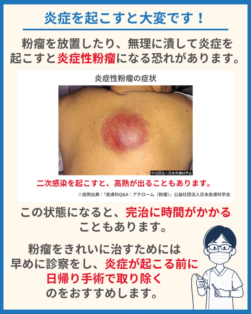粉瘤(ふんりゅう)は、炎症を起こすと大変です