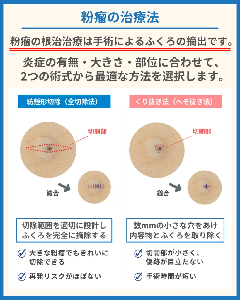 粉瘤(ふんりゅう)の治療法