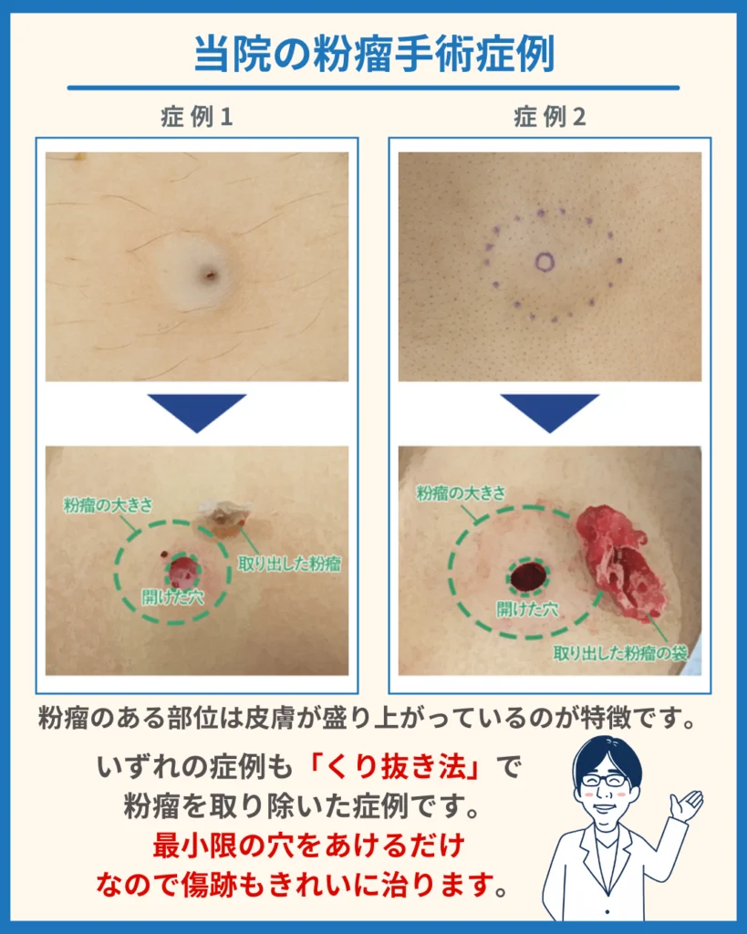 当院の粉瘤(ふんりゅう)手術の症例